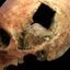Inca Skull Surgery
