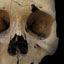 Inca Skull Surgery